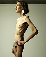 Slim forms and Thin Anorexic Beauties